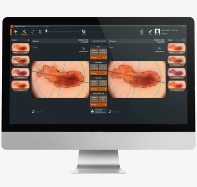 FotoFinder Moleanalyser Pro